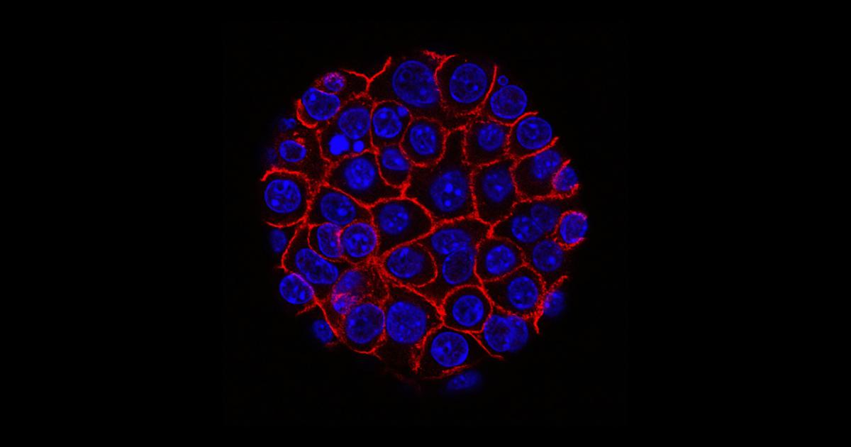 Pankreas Kanseri: MYC Geni'nin Bozulması ile Tümörlerin Küçülmesi