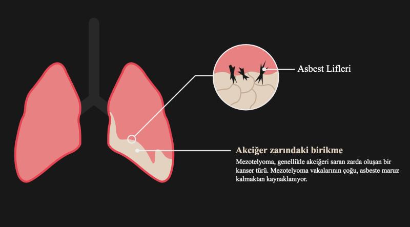 Asbestli akciğer