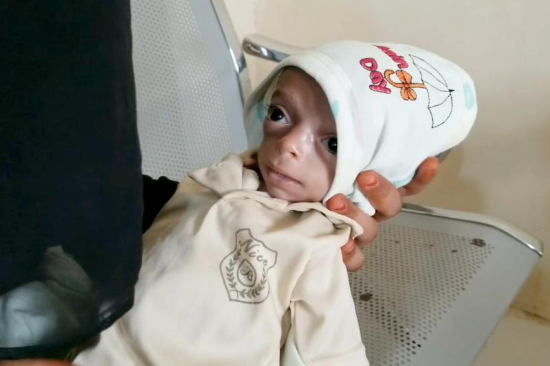 Yemenli çocuk İbrahim Abdo, kilo kaybı, düşük tansiyon ve iştahsızlık gibi şiddetli bir akut yetersiz beslenmeyle mücadele ediyor.jpg