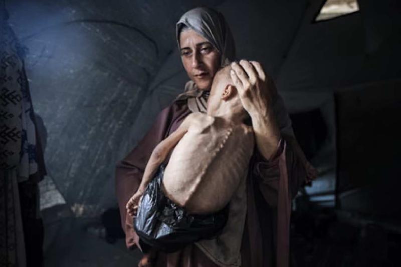 Gazze’de hayatını tehdit eden yetersiz beslenmeyle mücadele eden 18 aylık Muhammed Zekeriya Eyüp el-Matuk / Fotoğraf: Anadolu Ajansı