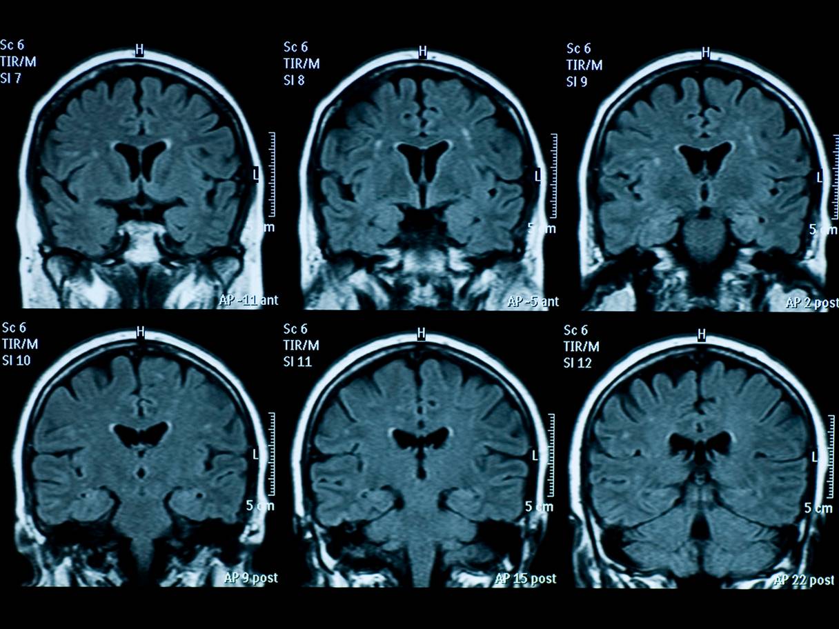 beyin tomografisi.jpg